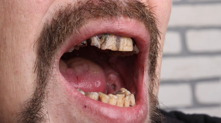 Chemicals Resulting from Methamphetamine Use - Extensive Tooth Decay