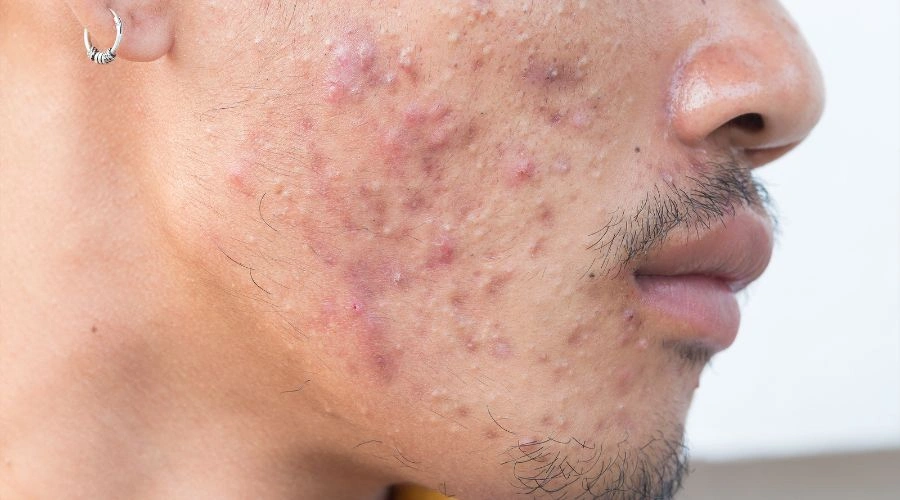 Decreased Collagen Production Lowers Skin Health from Smoking Cannabis