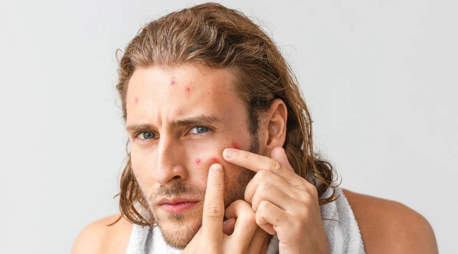 How Weed Impacts Skin Health and Leads to Acne Breakouts
