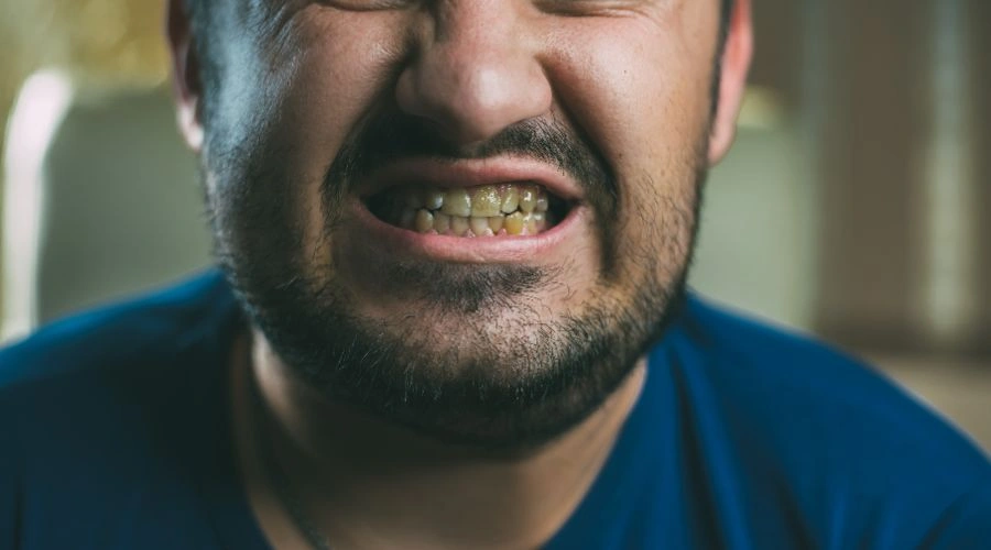 Meth Mouth - Severe Tooth Decay and Gum Disease