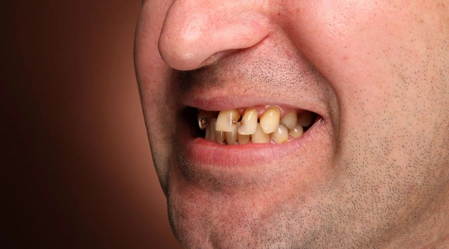 Teeth Grinding in Meth Addiction