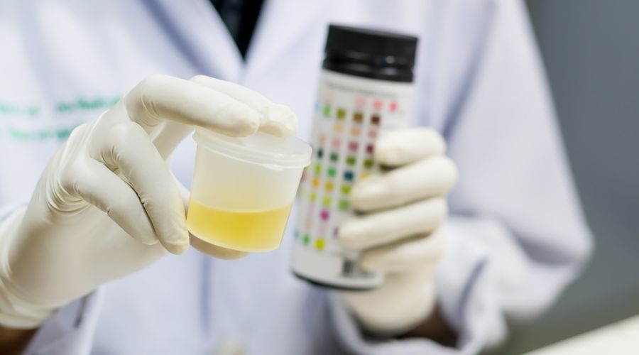 Image of a urine specimen - How Long Does Cocaine Stay in Your System