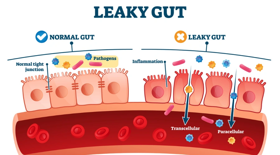 Illustration of inflamed intestines showing leaky gut and disrupted gut bacteria