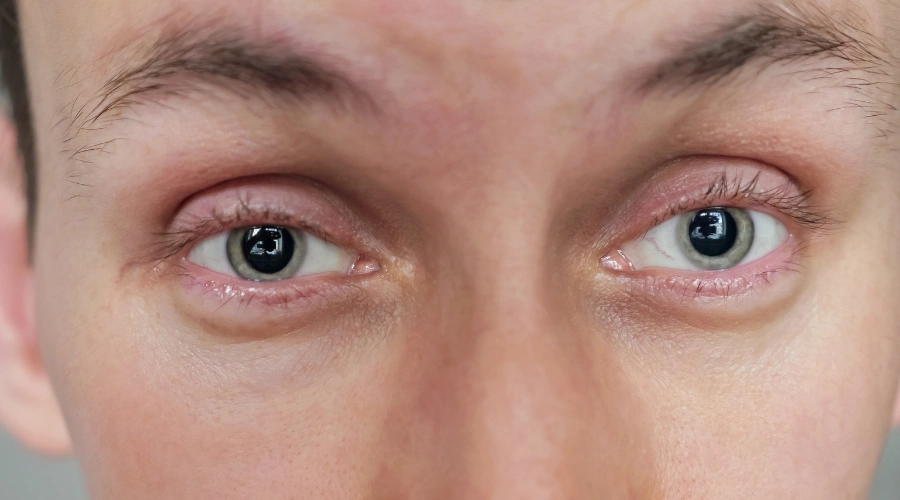Image of a close-up of a person’s eyes with noticeably dilated pupils